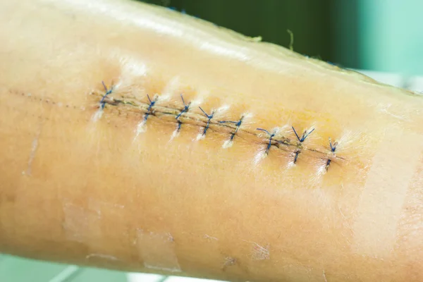 Herida de sutura en la pierna — Foto de Stock