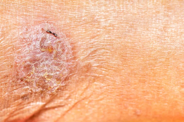 Blisters Close Homem Velho Pés Infecção Epiderme Exterior Doenças Pele — Fotografia de Stock