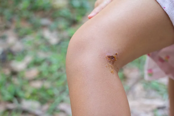 Purulent wounds caused by allergies , Dirty water or Skin diseases on the legs of girls