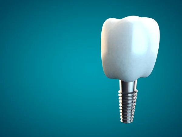 Implante molar dental Higiene dental Dentista 3D azul — Foto de Stock