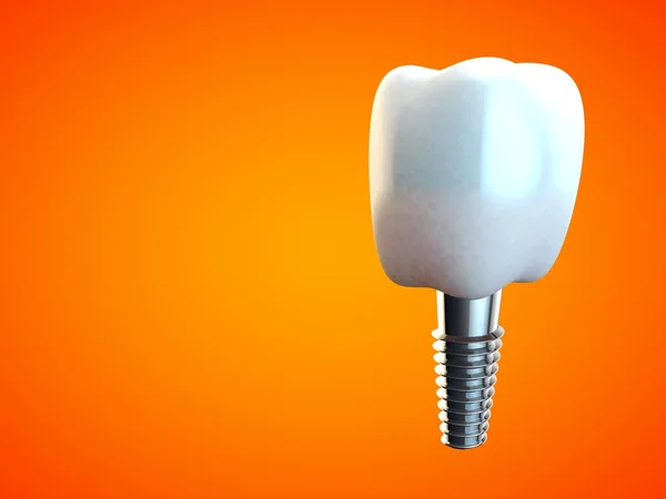 Implante molar dental Higiene dental Dentista 3D naranja — Foto de Stock