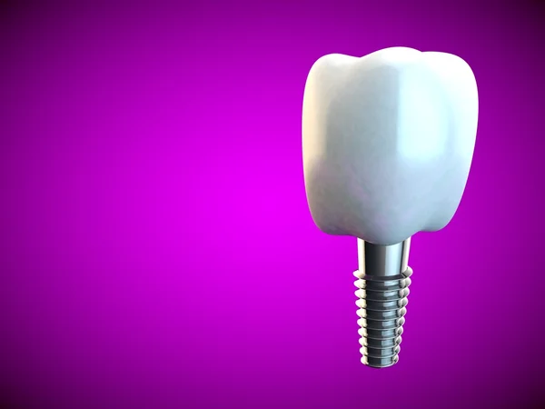 Tooth molar implant Dental Hygiene Dentist 3D pink — Stock Photo, Image