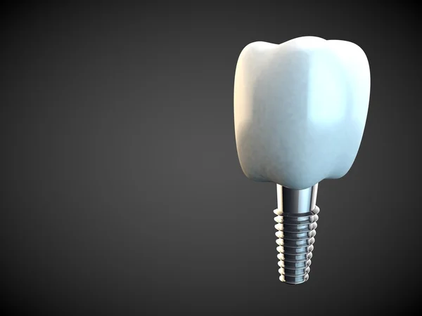 Implante molar dentário Higiene dentária Dentista 3D preto — Fotografia de Stock
