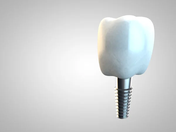 Implante molar dentário Higiene dentária Dentista 3D branco — Fotografia de Stock