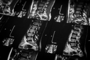 MRI omurga