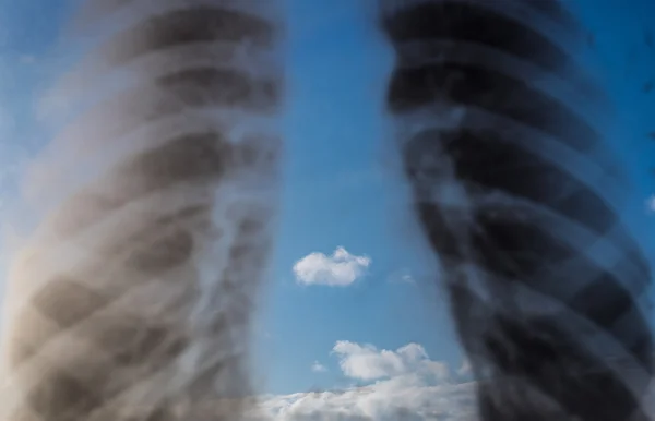 Rentgen los pulmones — Foto de Stock