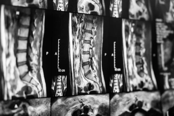 MRI omurga — Stok fotoğraf