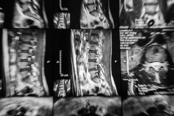 MRI omurga — Stok fotoğraf