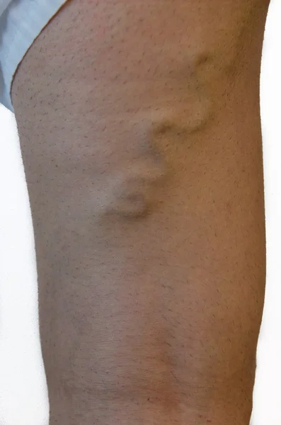 Varicose veins on a leg. — Stock Photo, Image