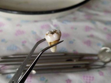 Testereyle alınmış yirmilik diş cımbızı ve yakın plan diş aletleri.