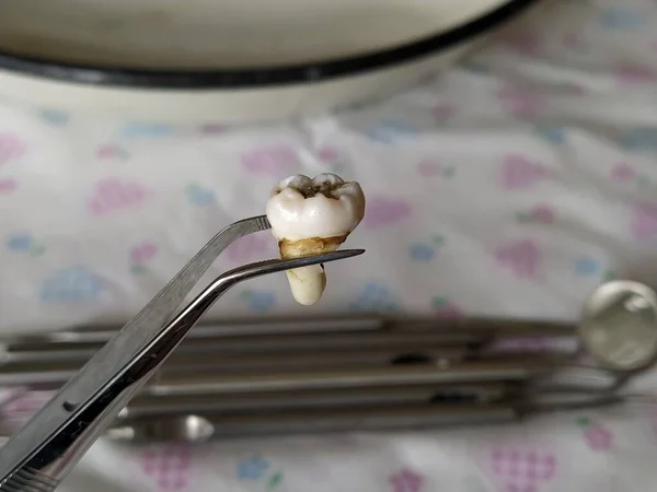 Sawed extracted wisdom tooth in tweezers and dental tools on background close-up