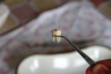 Cımbızda çıkarılan yirmilik dişi