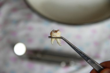 Cımbızda çıkarılan yirmilik dişi