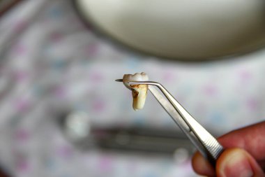 Cımbızda çıkarılan yirmilik dişi