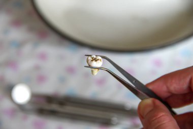 Cımbızda çıkarılan yirmilik dişi