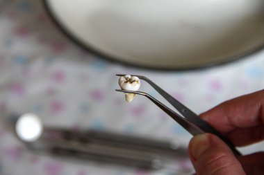 Cımbızda çıkarılan yirmilik dişi