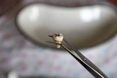 Cımbızda azı dişi çıktı.