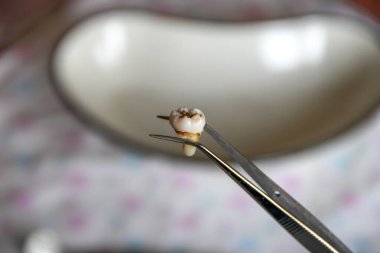 Cımbızda azı dişi çıktı.