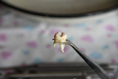 Cımbızda azı dişi çıktı.