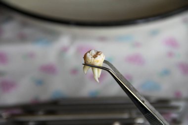 Cımbızda azı dişi çıktı.