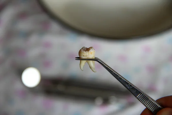Extracted wisdom tooth in the tweezers