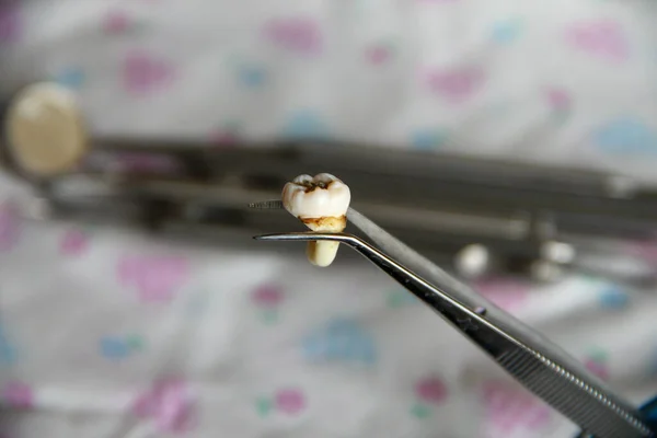 Extracted tooth in tweezers against the background of dental instruments