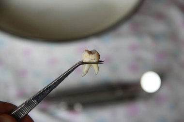 Cımbızda çıkarılan yirmilik dişi