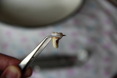 Cımbızda çıkarılan yirmilik dişi