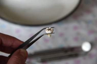 Cımbızda çıkarılan yirmilik dişi