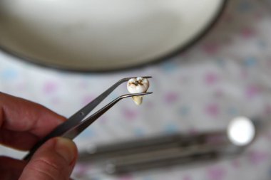 Cımbızda çıkarılan yirmilik dişi