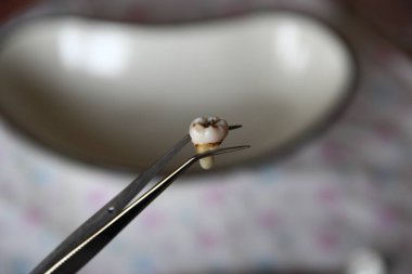 Cımbızda azı dişi çıktı.