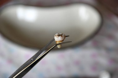 Cımbızda azı dişi çıktı.