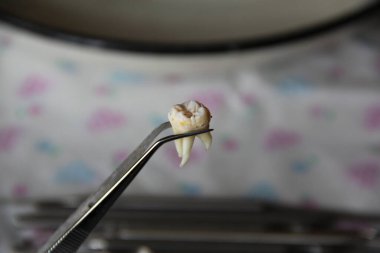 Cımbızda azı dişi çıktı.