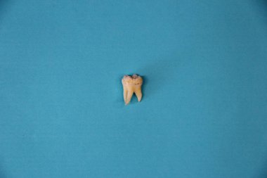 Mavi arka planda çıkarılmış yirmilik dişi, üst görünümde.