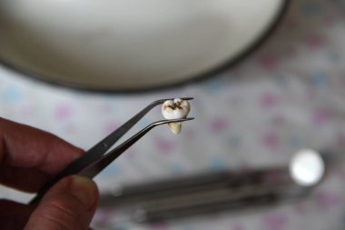 Cımbızda çıkarılan yirmilik dişi