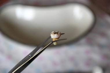 Cımbızda azı dişi çıktı.