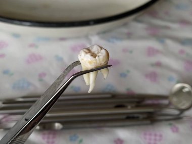 Diş aletlerinin arka planında cımbızla çekilen diş, yakın plan.