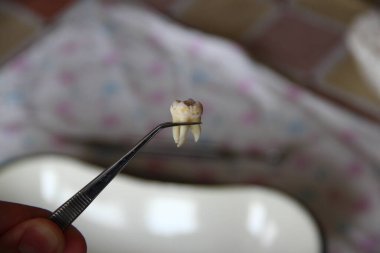 Cımbızda çıkarılan yirmilik dişi