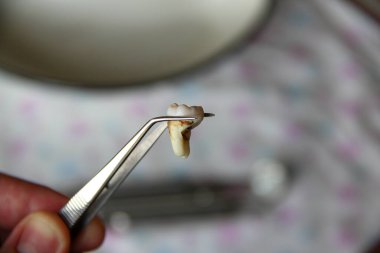 Cımbızda çıkarılan yirmilik dişi