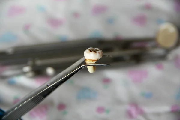 Extracted tooth in tweezers against the background of dental instruments