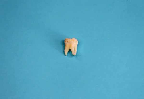 Extracted wisdom tooth on the blue background, close up