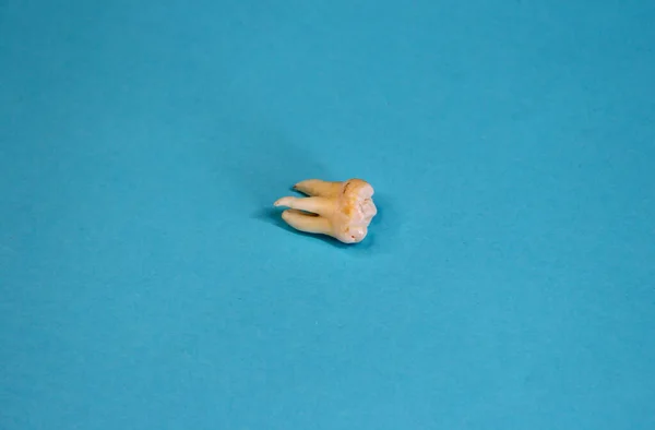 Extracted wisdom tooth on the blue background, close-up