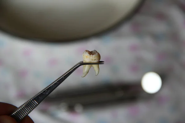 Extracted wisdom tooth in the tweezers