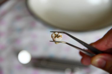 Diş aletlerinin arka planına karşı cımbızla çekilen diş.