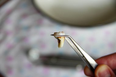 Cımbızda çıkarılan yirmilik dişi