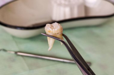 Cımbızda çıkarılan yirmilik dişi