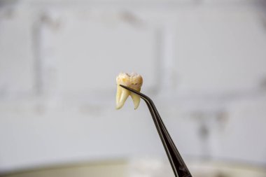 Bir dişçinin muayenehanesinde cımbızda çıkarılan diş.