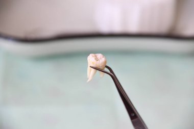 Cımbızda çıkarılan diş.