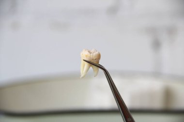 Cımbızda çıkarılan diş.