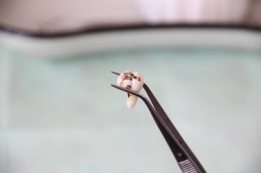 Diş tablasının arka planında cımbızla çekilen diş.